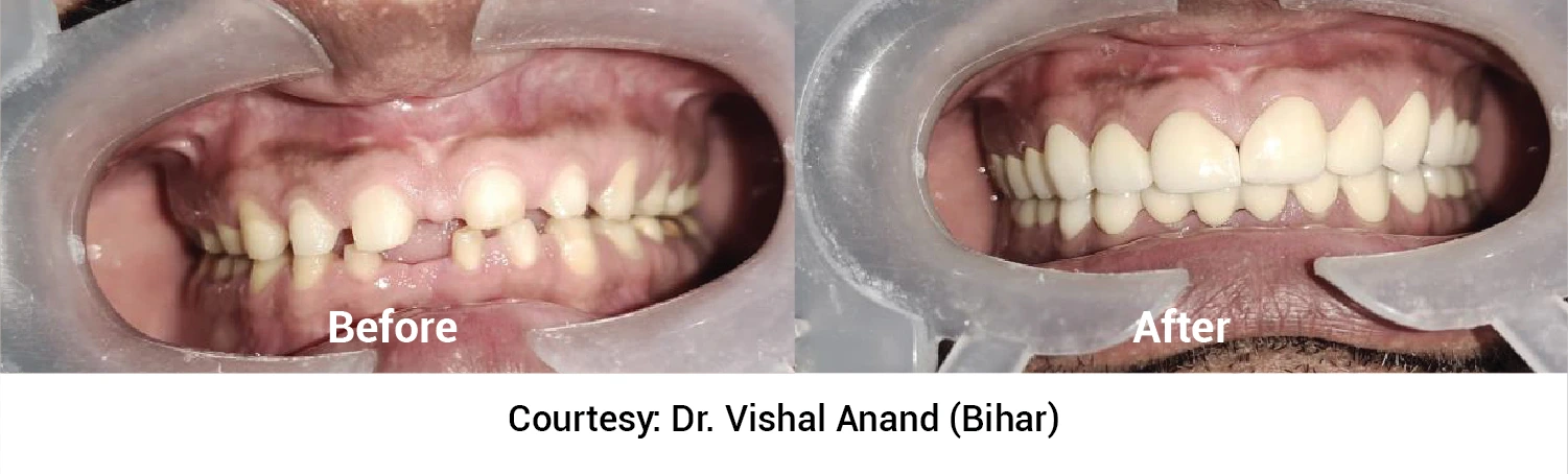  anterior zirconia crown 