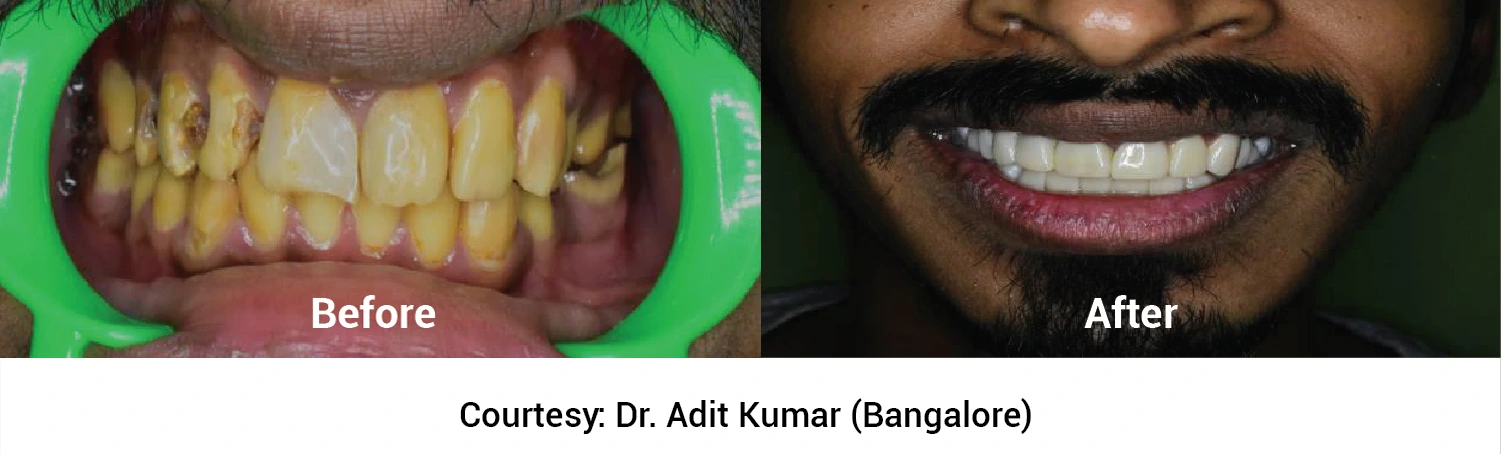 zirconia crowns before and after