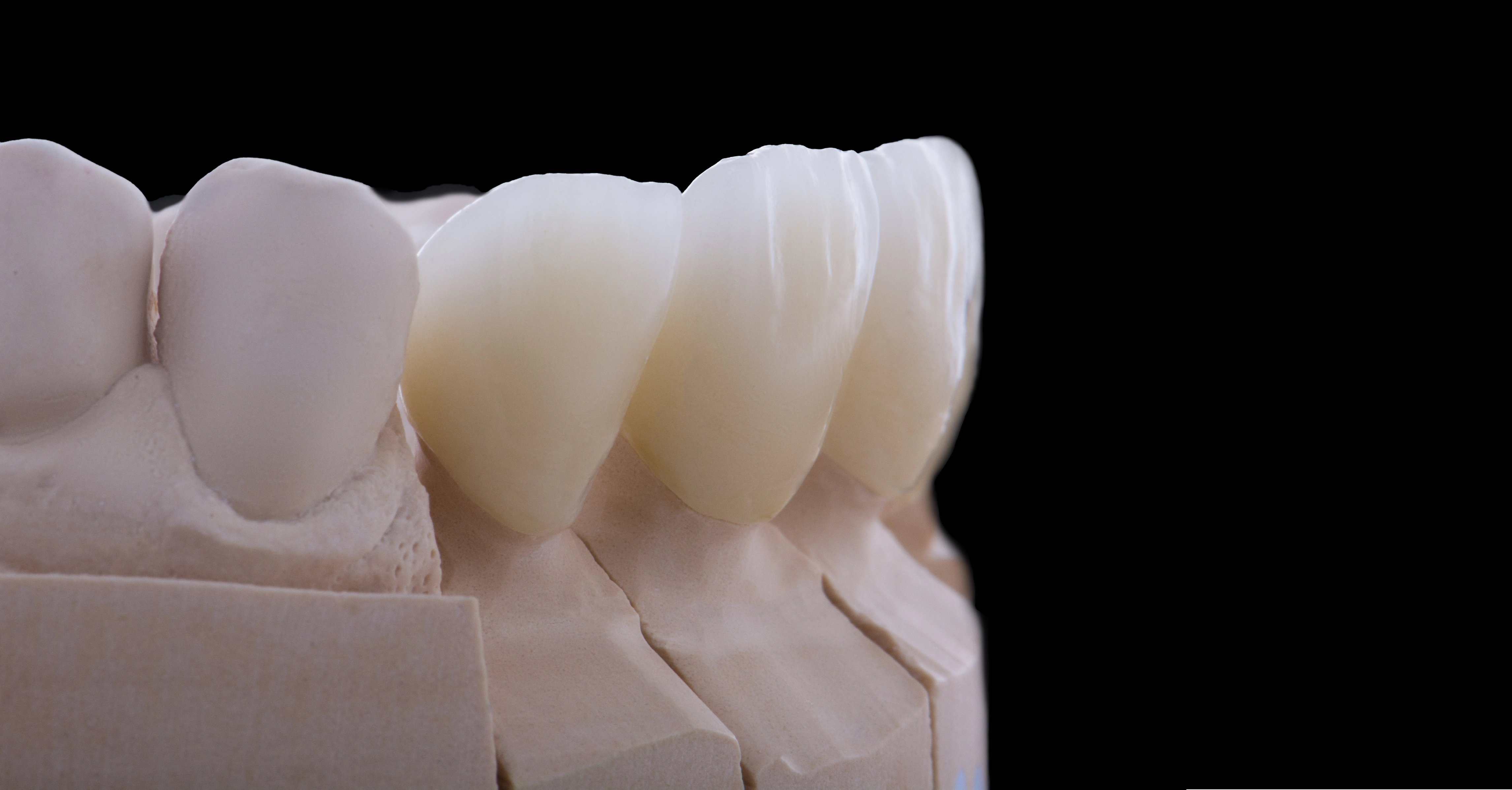 zirconia crown price 