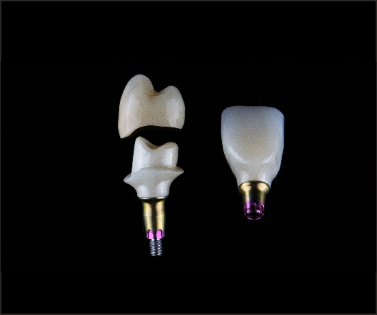 Smart Abutment