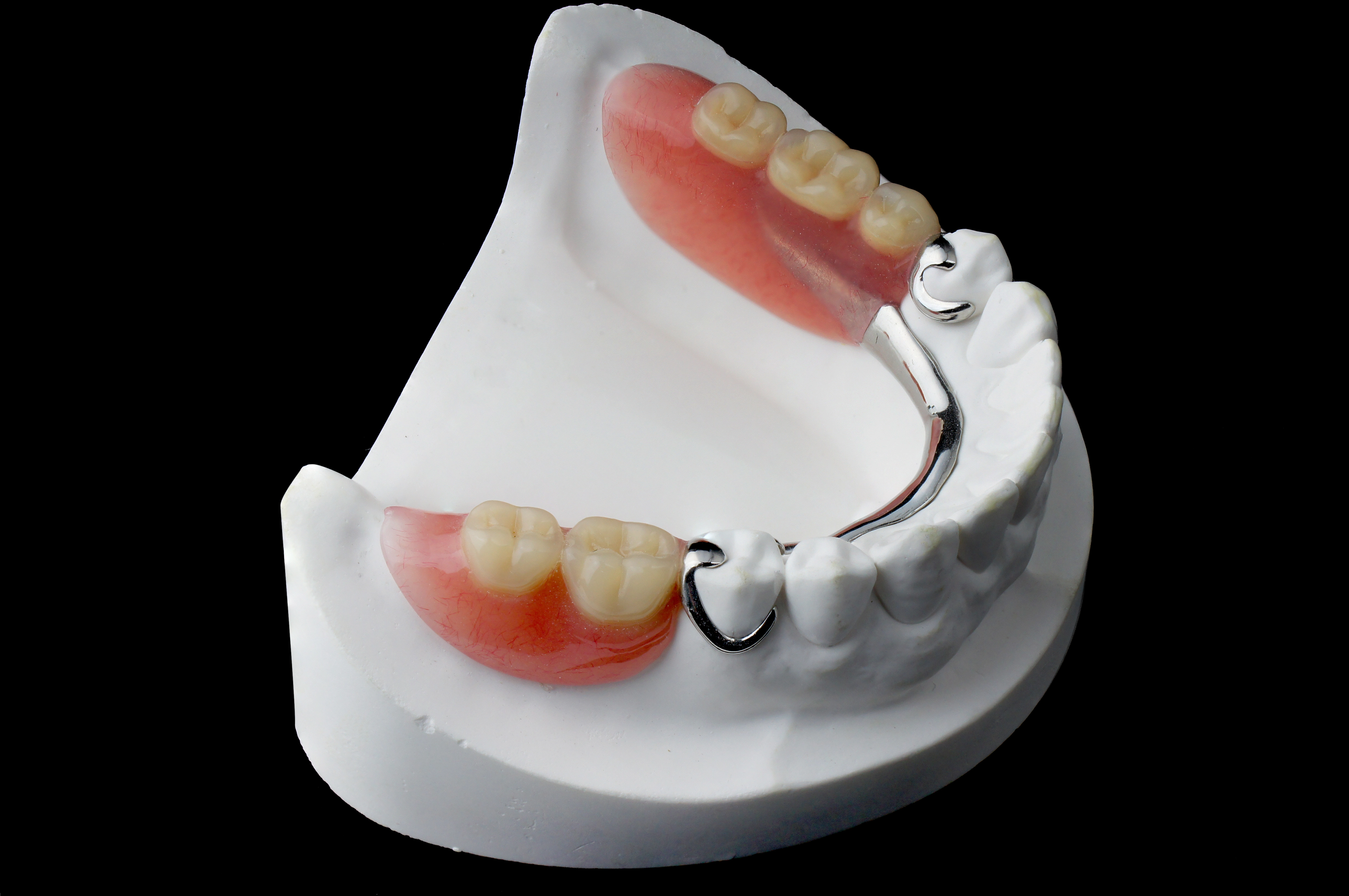 cast partial denture