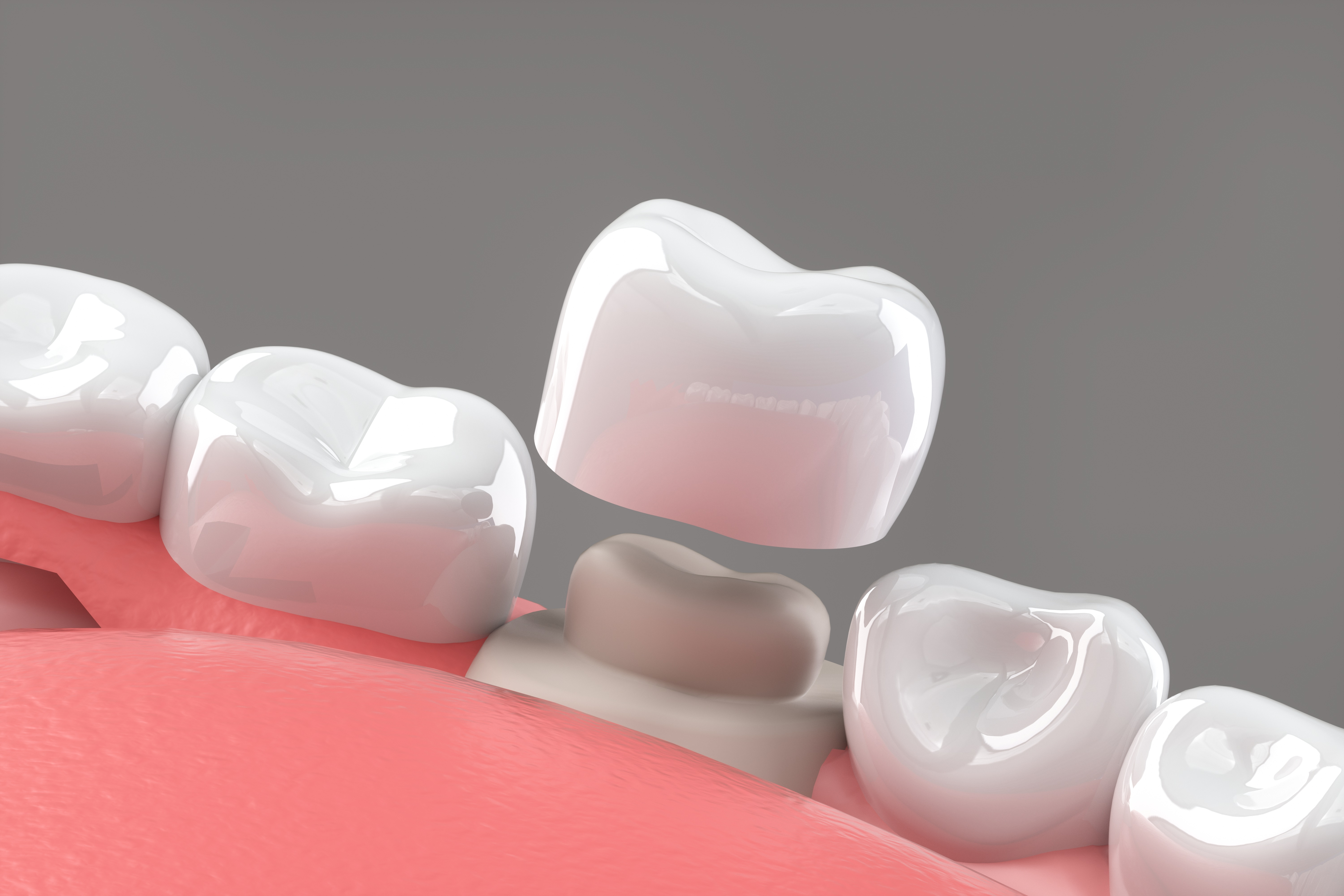 Complete guide on Dental crowns