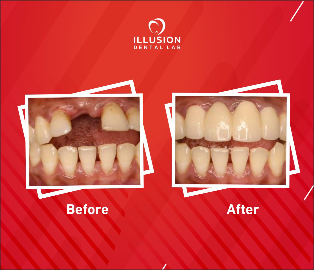IDL - Before and After